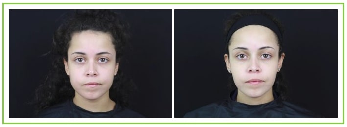 young woman before and after masseter botox with enlarged lower face before treatment