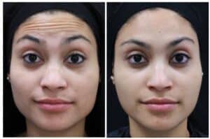 Before and after treatment of frontalis with Botox