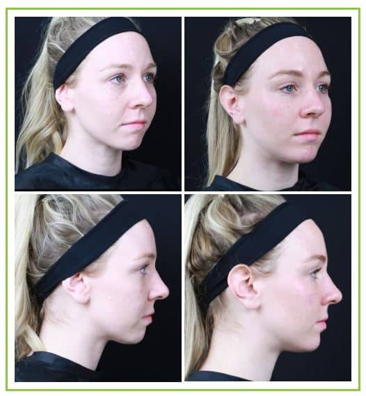 Before and after undereye filler treatment using Restylane