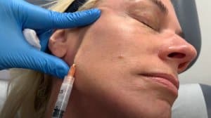 Face rejuvenation using Sculptra and Restylane Defyne