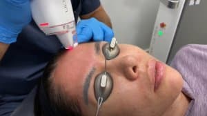 LaseMD Ultra laser treatment