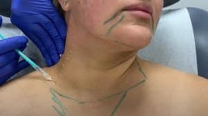 MicroDysport Neck Rejuvenation