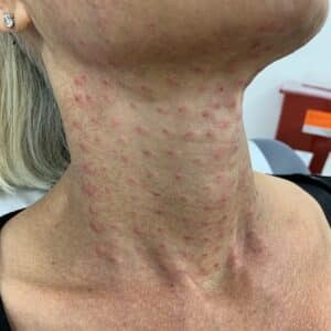Neck immediately after MicroBotox 0