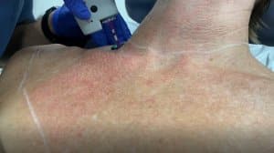 VBeam treatment for sundamage on chest