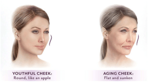 correcting facial volume loss 300x167 1