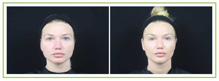 young female patient before and after masseter dysport injections, lower less face less swollen after treatment
