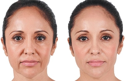 juvederm before after1 0