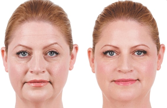 juvederm before after2 0