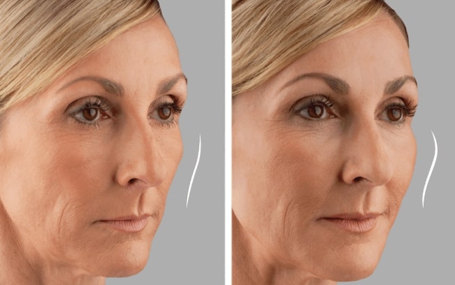 juvederm voluma before after2 0