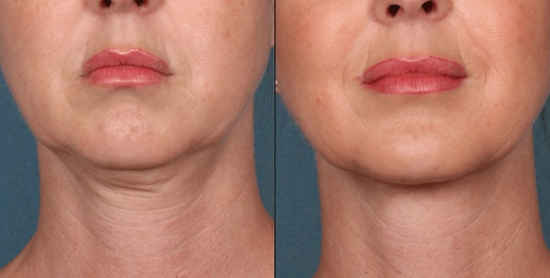 kybella before after1 0