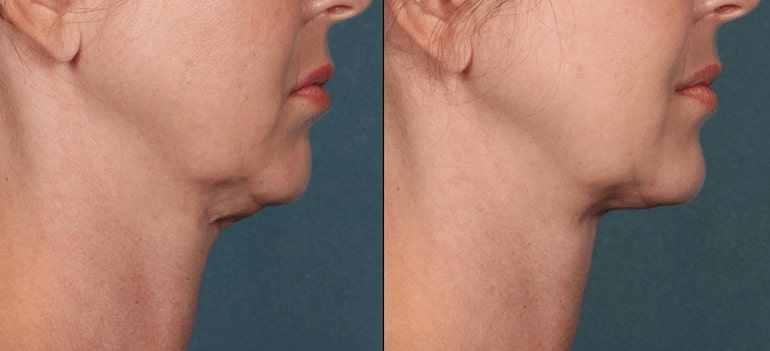 kybella before after2 0