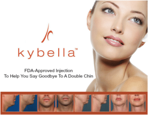 kybella injection 300x233 1