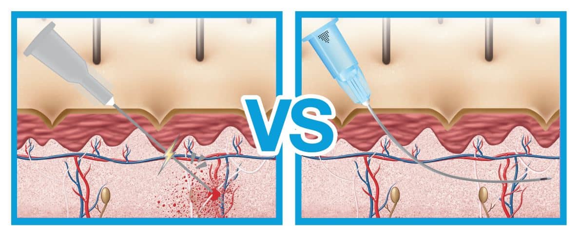 needle versus cannula