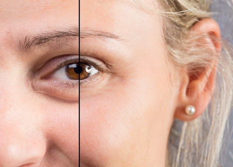 How to Treat Under-Eye Bags - Miami Skin & Vein