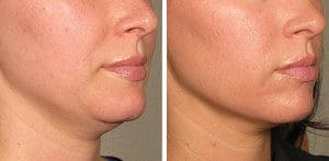 ultherapy 0132p h before 120daysafter lower low res e1426567985540 300x147 300x147 1