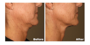 ultherapy before after 300x151 1