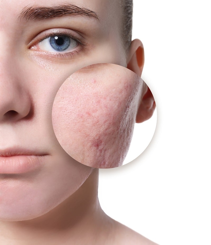young woman’s face with zoomed in view of rolling acne scars on cheek