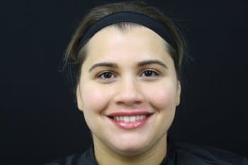 After Image: Dermal Fillers - front