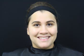 Before Image: Dermal Fillers - front
