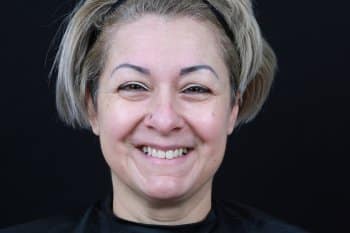Before Image: Dermal Fillers - front