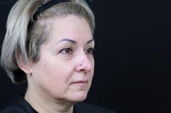 Before Image: Dermal Fillers - right-front-oblique