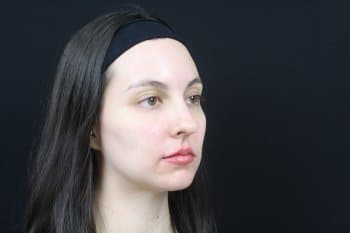 After Image: Dermal Fillers - right-front-oblique