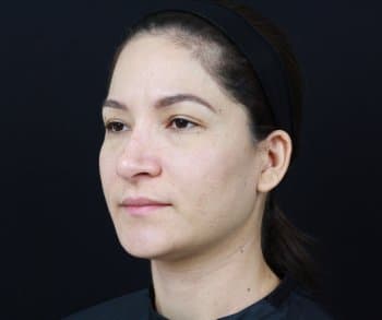 Before Image: Dermal Fillers - left-front-oblique