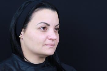 Before Image: Dermal Fillers - right-front-oblique