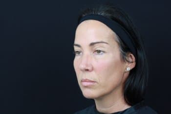 Before Image: Dermal Fillers - left-front-oblique