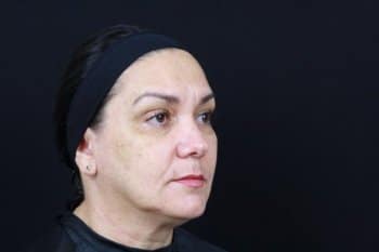After Image: Dermal Fillers - right-front-oblique
