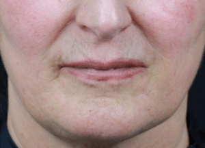 Dermal Fillers