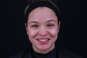 Dermal Fillers