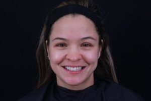 Dermal Fillers