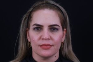 Dermal Fillers