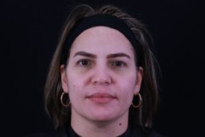 Dermal Fillers