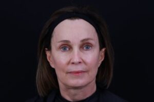 Dermal Fillers