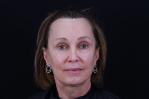 Dermal Fillers