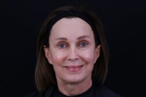 Skin Rejuvenation