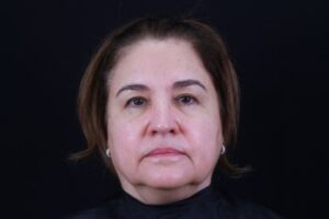 Skin Rejuvenation