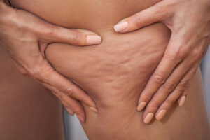 woman pinching cellulite on her thigh