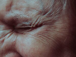 wrinkles restylane lyft