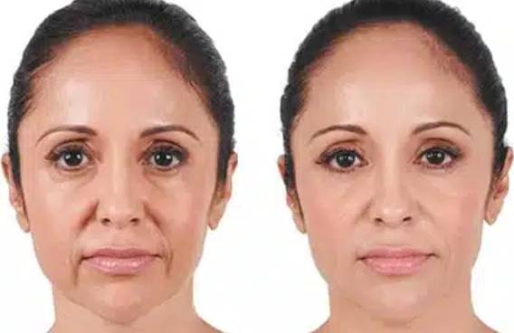 juvederm before after2 0