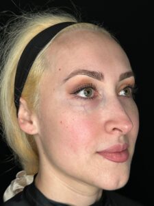 Undereye and temple filler